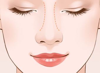 假体隆鼻手术会有危险吗?